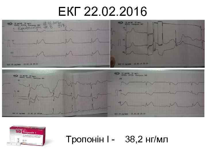ЕКГ 22. 02. 2016 Тропонін І - 38, 2 нг/мл 
