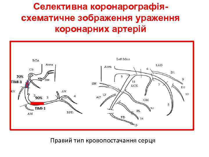 Селективна коронарографіясхематичне зображення ураження коронарних артерій 70% ТІМІ-1 90% ТІМІ-1 Правий тип кровопостачання серця