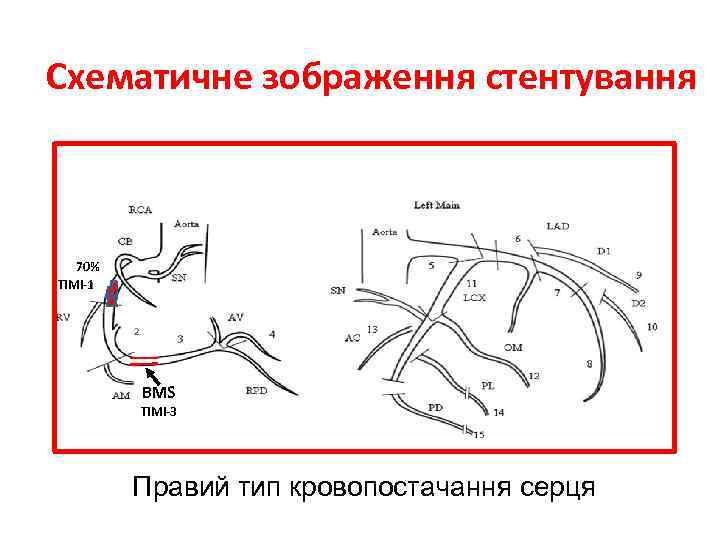 Cхематичне зображення стентування 70% ТІМІ-1 BMS ТІМІ-3 Правий тип кровопостачання серця 