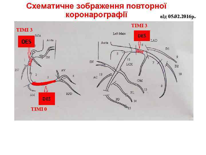 Схематичне зображення повторної коронарографії від 05. 02. 2016 р. ТІМІ 3 DES DES ТІМІ