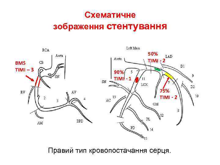 Схематичне зображення стентування BMS TIMI – 3 50% TIMI - 2 90% TIMI -