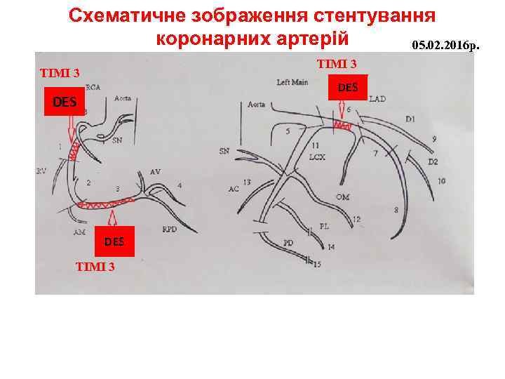 Схематичне зображення стентування коронарних артерій 05. 02. 2016 р. ТІМІ 3 DES DES ТІМІ