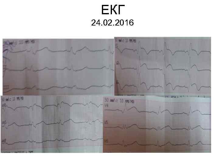 ЕКГ 24. 02. 2016 