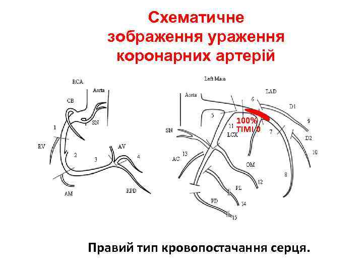 Схематичне зображення ураження коронарних артерій 100% ТІМІ 0 Правий тип кровопостачання серця. 