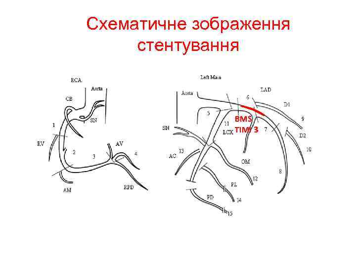 Схематичне зображення стентування BMS TIMI 3 