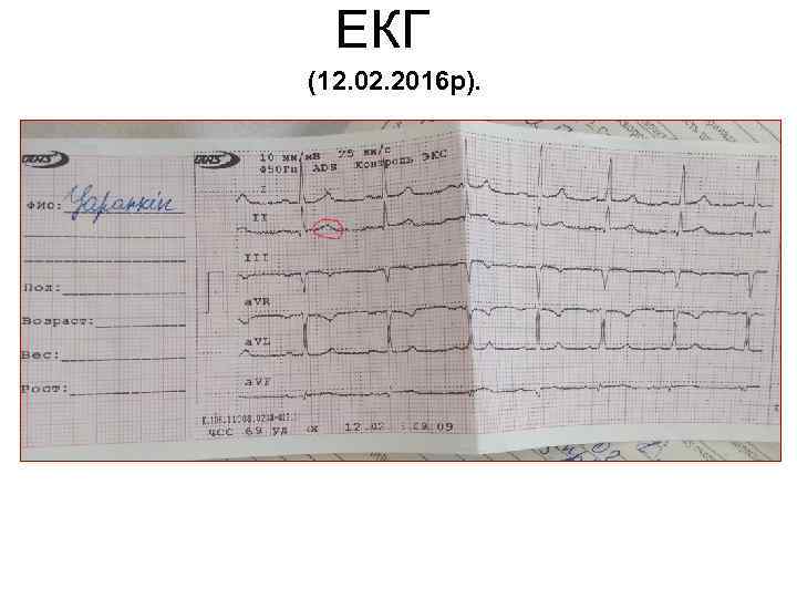 ЕКГ (12. 02. 2016 p). 