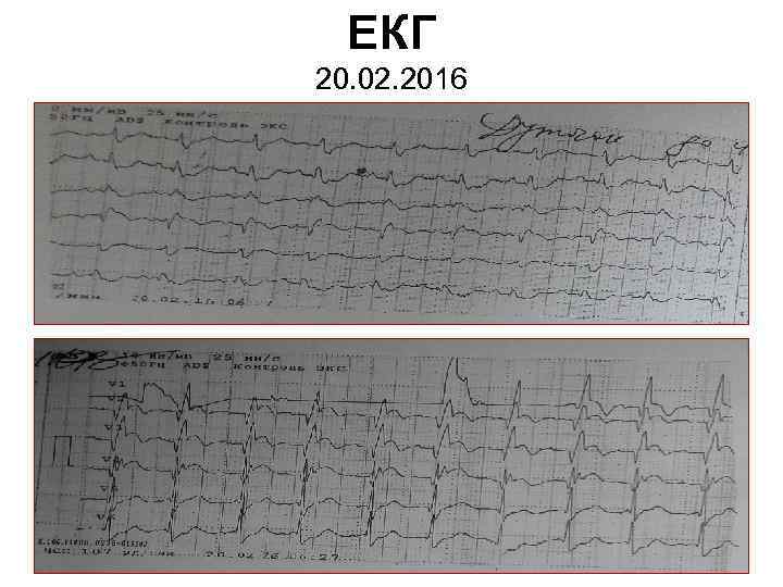 ЕКГ 20. 02. 2016 