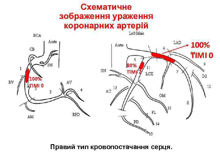 Схематичне зображення ураження коронарних артерій 100% ТІМІ 0 80% ТІМІ 2 100% ТІМІ 0