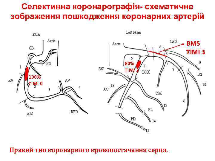 Сосуды сердца схема коронарография