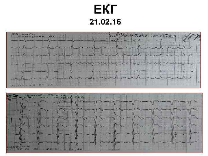 ЕКГ 21. 02. 16 