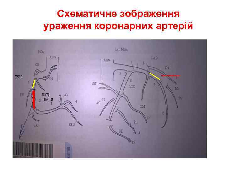 Схематичне зображення ураження коронарних артерій 75% Пристінкові зміни 99% TIMI 0 