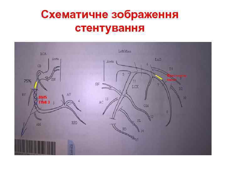 Схематичне зображення стентування Пристінкові зміни 75% BMS TIMI 3 