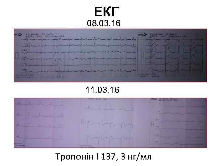 ЕКГ 08. 03. 16 11. 03. 16 Тропонін І 137, 3 нг/мл 