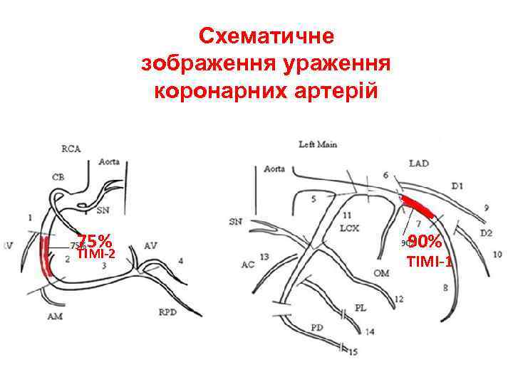 Схематичне зображення ураження коронарних артерій 75% TIMI-2 90% TIMI-1 