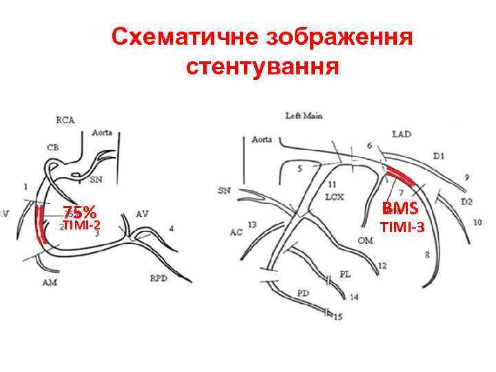 Схематичне зображення стентування 75% TIMI-2 BMS TIMI-3 