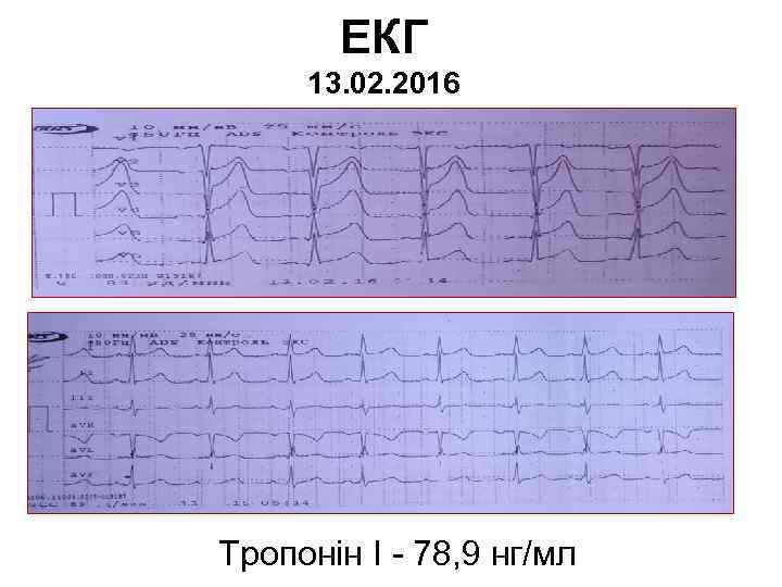 ЕКГ 13. 02. 2016 Тропонін І - 78, 9 нг/мл 