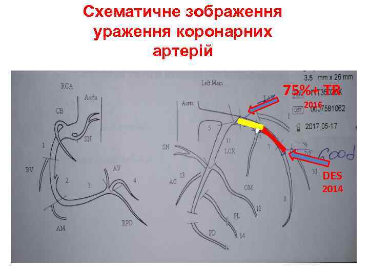 Схематичне зображення ураження коронарних артерій 75%+ TR 2016 DES 2014 