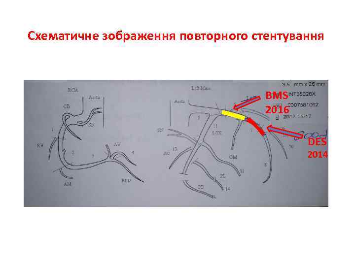 Cхематичне зображення повторного стентування BMS 2016 DES 2014 