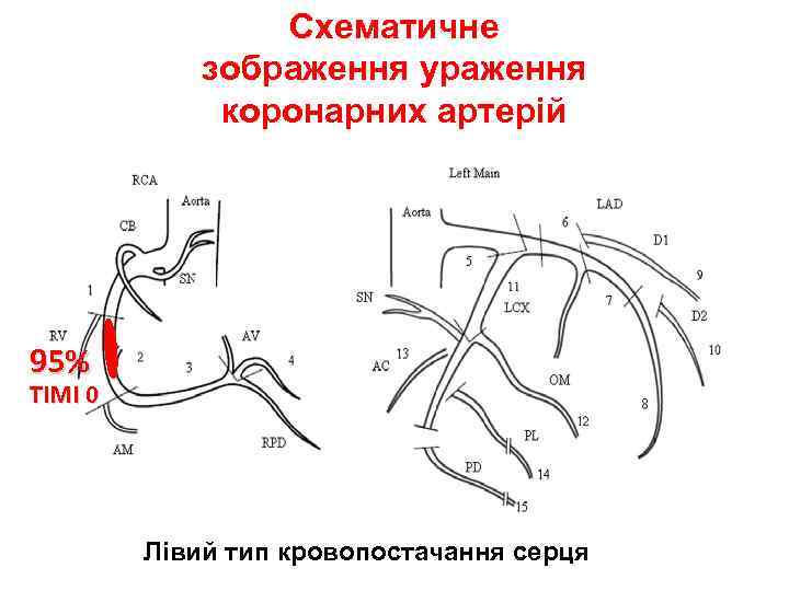Схематичне зображення ураження коронарних артерій 99% 95% TIMI 0 Лівий тип кровопостачання серця 
