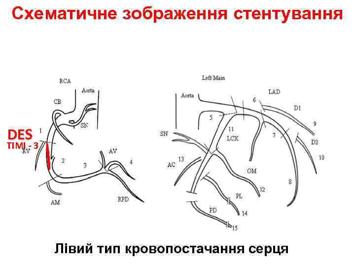 Схематичне зображення стентування 99% DES TIMI - 3 Лівий тип кровопостачання серця 