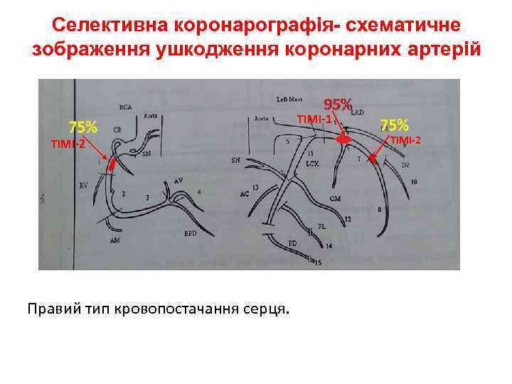 Селективна коронарографія- схематичне зображення ушкодження коронарних артерій TIMI-1 TIMI-2 Правий тип кровопостачання серця. TIMI-2