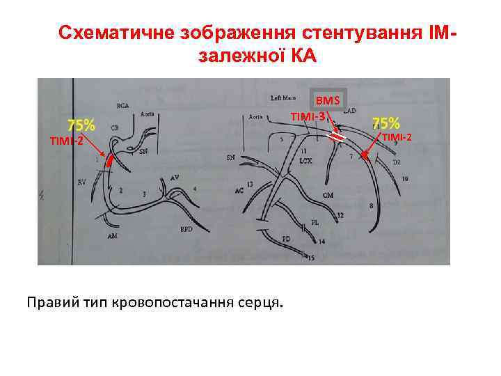 Схематичне зображення стентування ІМзалежної КА BMS TIMI-3 TIMI-2 Правий тип кровопостачання серця. TIMI-2 