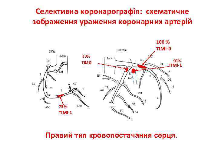 Селективна коронарографія: схематичне зображення ураження коронарних артерій 100 % TIMI-0 50% TIMI 2 95%