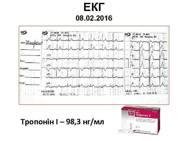 ЕКГ 08. 02. 2016 Тропонін І – 98, 3 нг/мл 