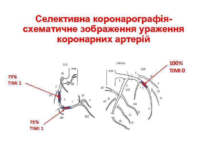 Селективна коронарографіясхематичне зображення ураження коронарних артерій 100% TIMI 0 75% TIMI 1 