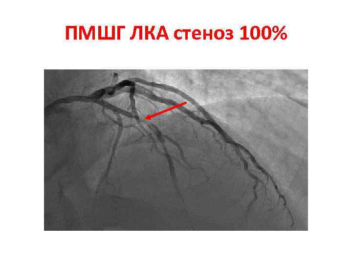 ПМШГ ЛКА стеноз 100% 