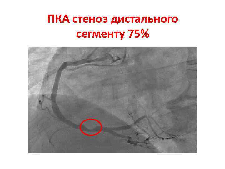 ПКА стеноз дистального сегменту 75% 
