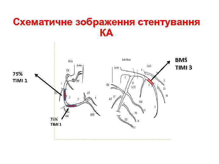 Схематичне зображення стентування КА BMS TIMI 3 75% TIMI 1 
