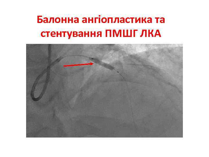 Балонна ангіопластика та стентування ПМШГ ЛКА 