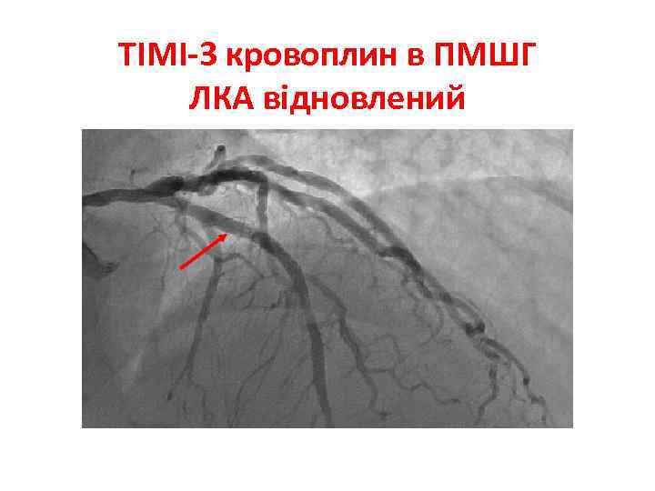 ТІМІ-3 кровоплин в ПМШГ ЛКА відновлений 