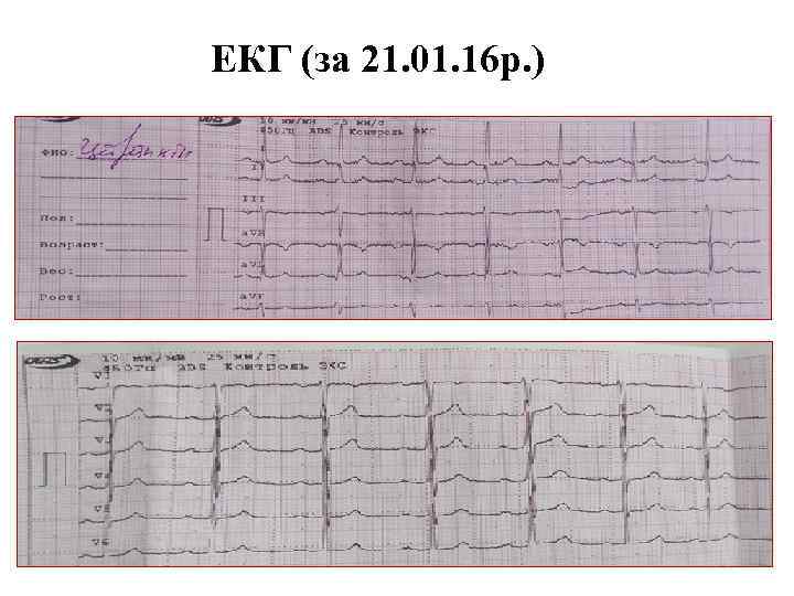 ЕКГ (за 21. 01. 16 p. ) 