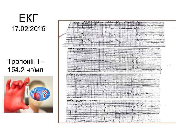 ЕКГ 17. 02. 2016 Тропонін І 154, 2 нг/мл 