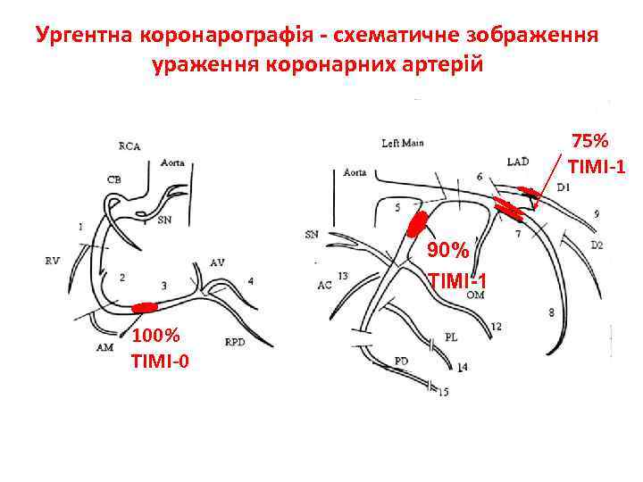 Ургентна коронарографія - схематичне зображення ураження коронарних артерій 75% TIMI-1 90% TIMI-1 100% TIMI-0