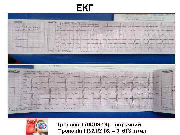 ЕКГ Тропонін І (06. 03. 16) – від’ємний Тропонін І (07. 03. 16) –