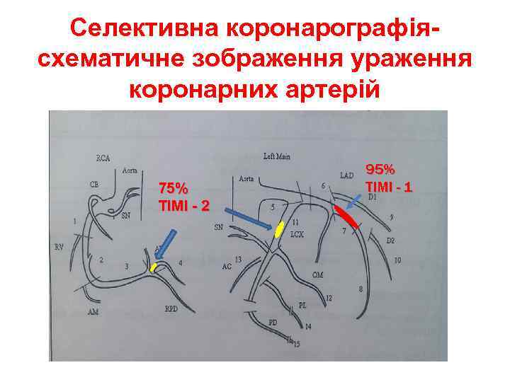 Селективна коронарографіясхематичне зображення ураження коронарних артерій 75% TIMI - 2 95% TIMI - 1