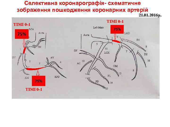 Селективна коронарографія- схематичне зображення пошкодження коронарних артерій 21. 01. 2016 р. ТІМІ 0 -1