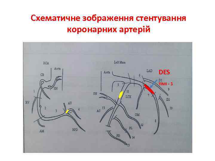 Cхематичне зображення стентування коронарних артерій DES TIMI - 3 