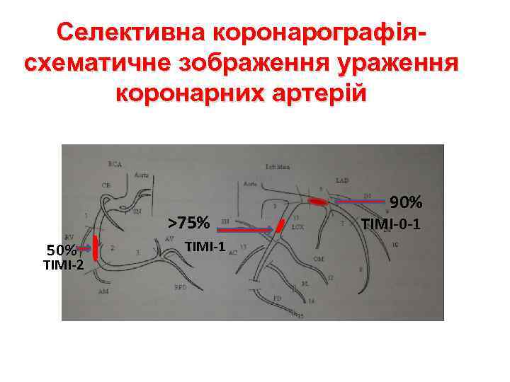Селективна коронарографіясхематичне зображення ураження коронарних артерій >75% 50% ТІМІ-2 ТІМІ-1 90% ТІМІ-0 -1 
