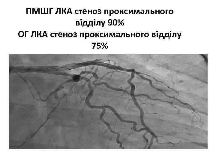 ПМШГ ЛКА стеноз проксимального відділу 90% ОГ ЛКА стеноз проксимального відділу 75% 