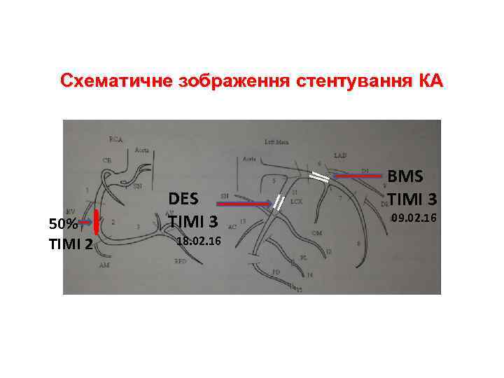 Схематичне зображення стентування КА 50% TIMI 2 DES TIMI 3 18. 02. 16 BMS