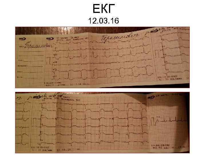ЕКГ 12. 03. 16 