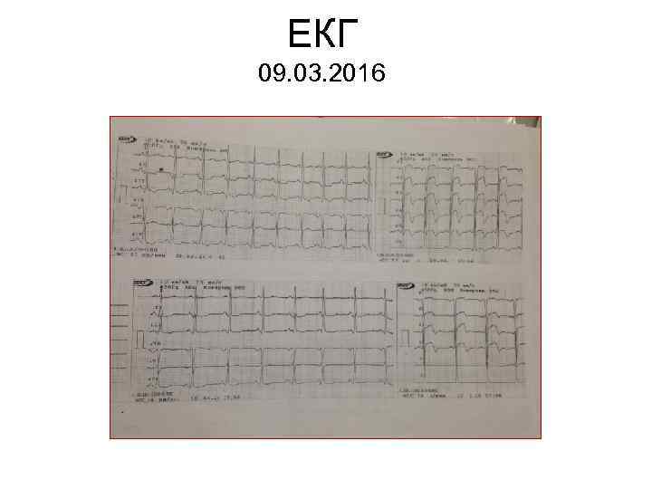 ЕКГ 09. 03. 2016 