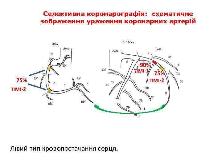 Селективна коронарографія: схематичне зображення ураження коронарних артерій 90% ТІМІ-1 75% ТІМІ-2 Лівий тип кровопостачання