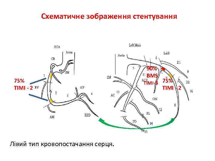 Cхематичне зображення стентування коронарних артерій 75% TIMI - 2 Лівий тип кровопостачання серця. 90%