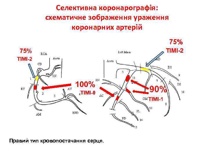 Сосуды сердца схема коронарография