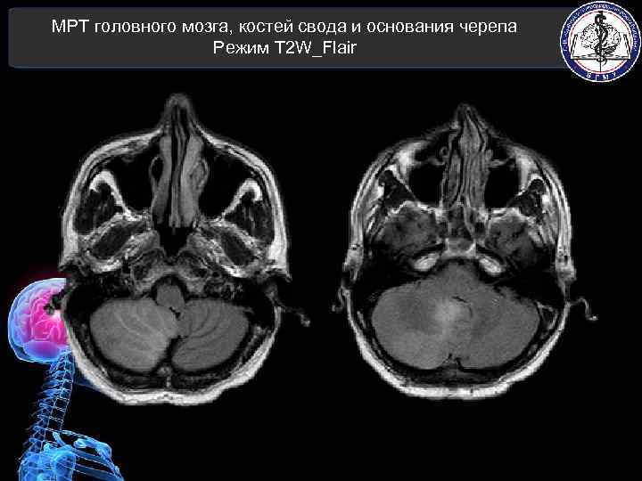 МРТ головного мозга, костей свода и основания черепа Режим T 2 W_Flair 